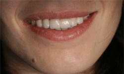 After: Dramatic Smile Improvement